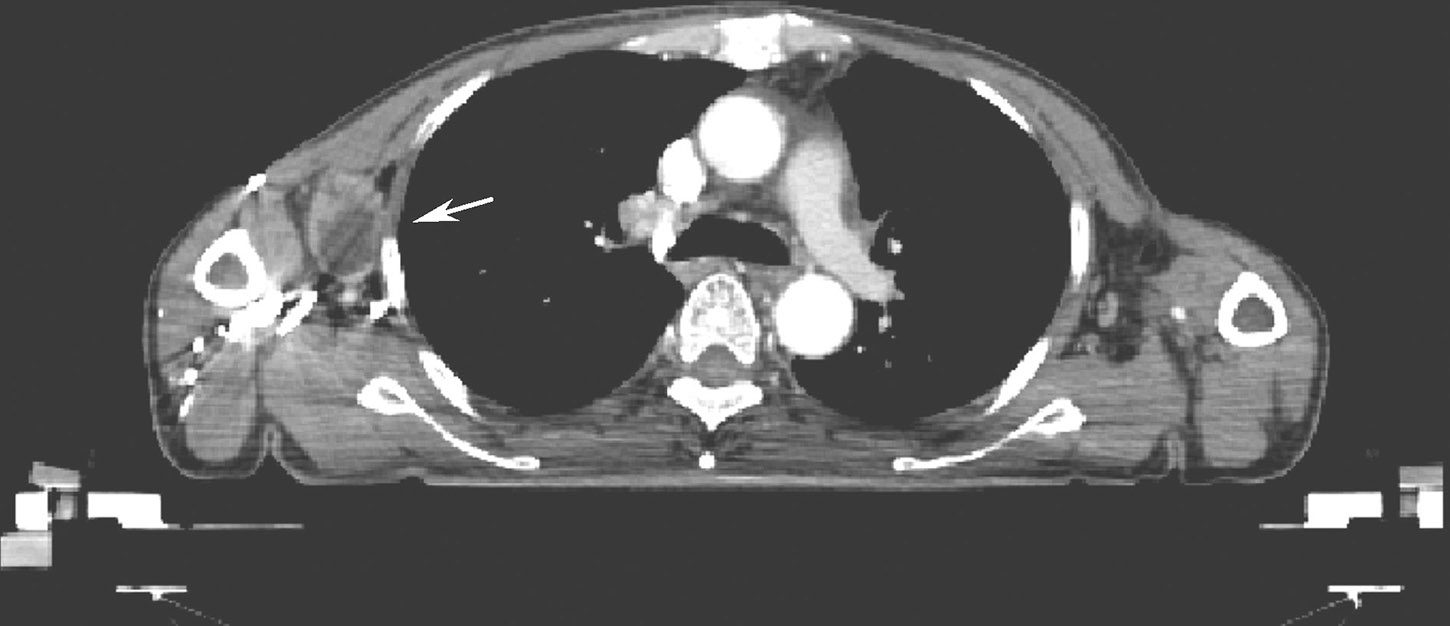 图3 右侧腋窝3cm×2cm淋巴结，伴中心坏死